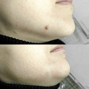 Before-and-after-use-of Skincell Pro