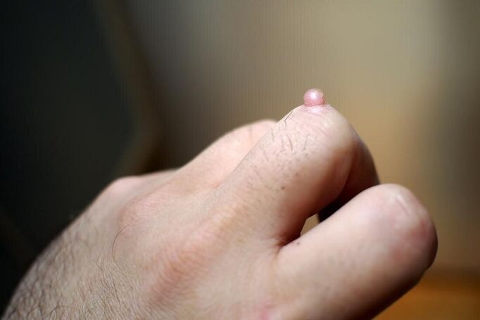 warts on finger