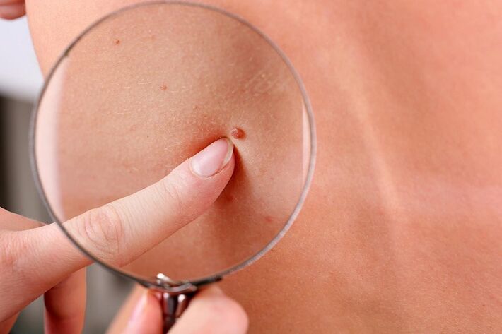 how to get rid of warts on face