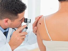 doctor examines papillomas about recommending removal with drugs