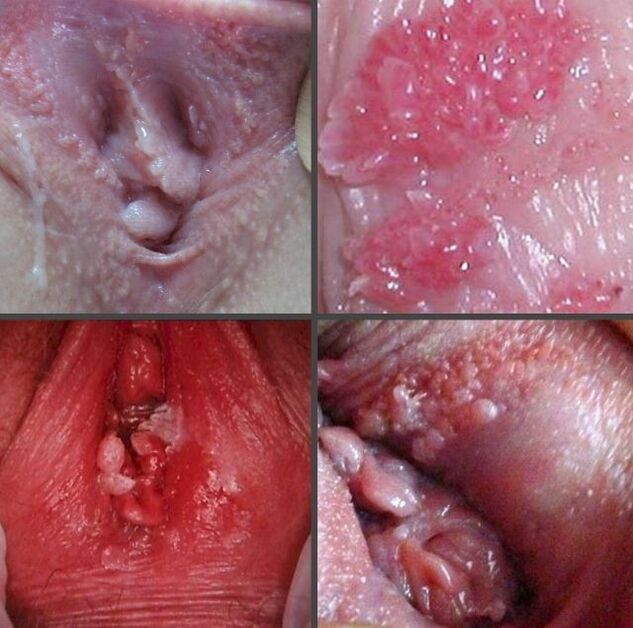 Close-up of papilloma in vagina