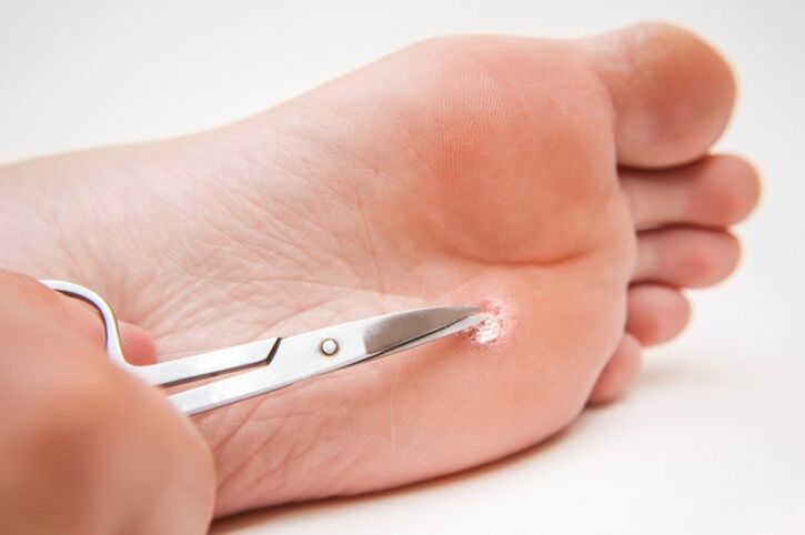 cut warts on feet