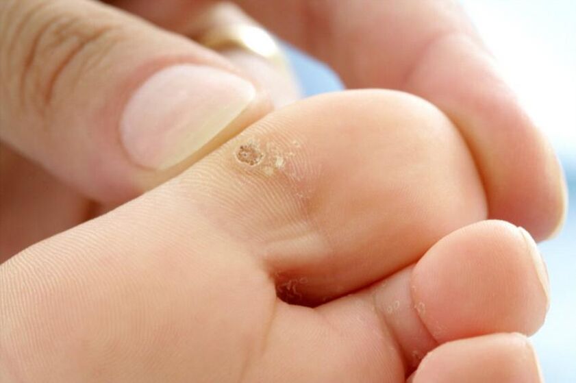 warts on toes