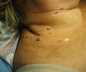 human papilloma virus on neck