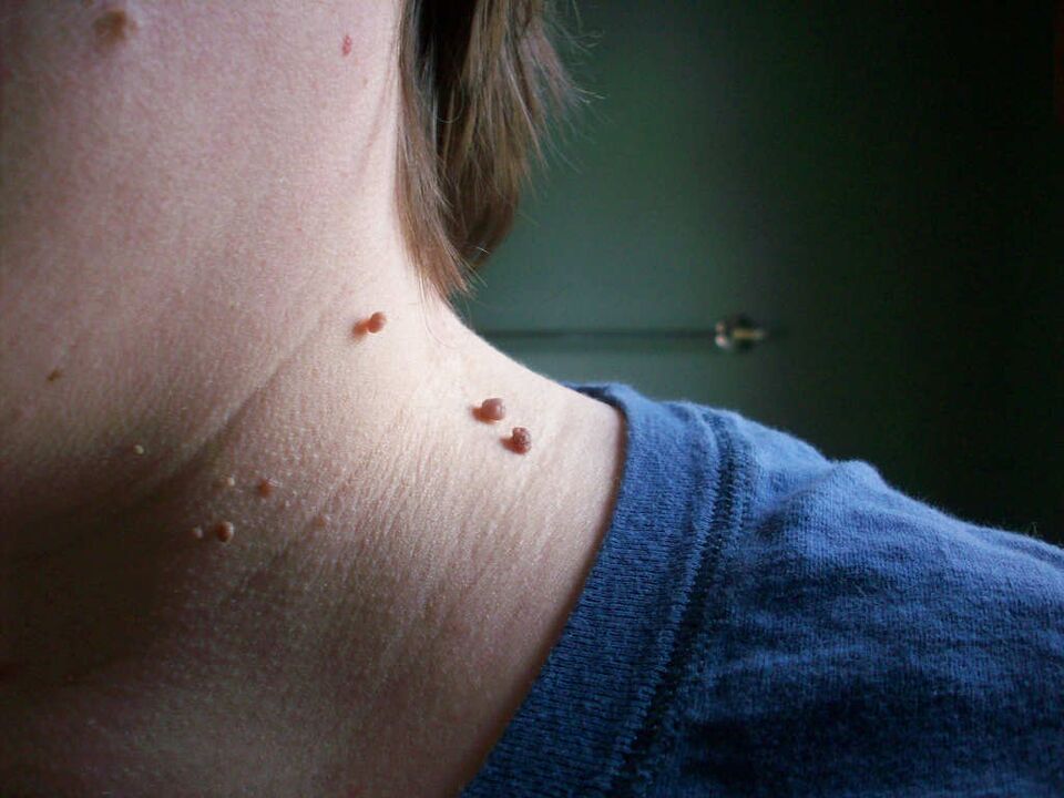 papilloma on neck how to treat