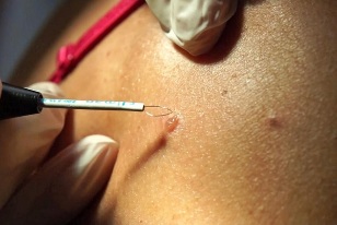 Papilloma removal by the radio wave method