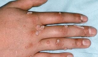 types of warts and methods for removing them