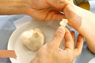 Treatment of papilloma with a garlic compress